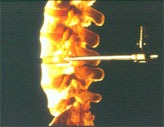 International Society for Minimal Intervention in Spinal Surgery pic